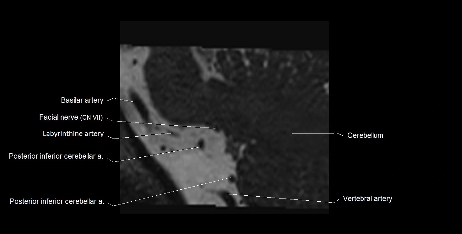 Internal auditory meatus (IAM) 3T sagittal cross sectional anatomy image 47.webp